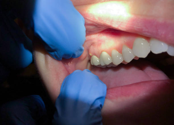 Best Emergency Tooth Extraction in Crocker, WA